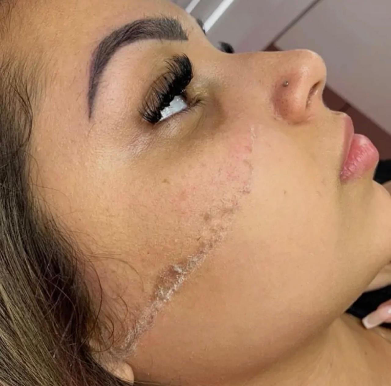 Dermaplaning