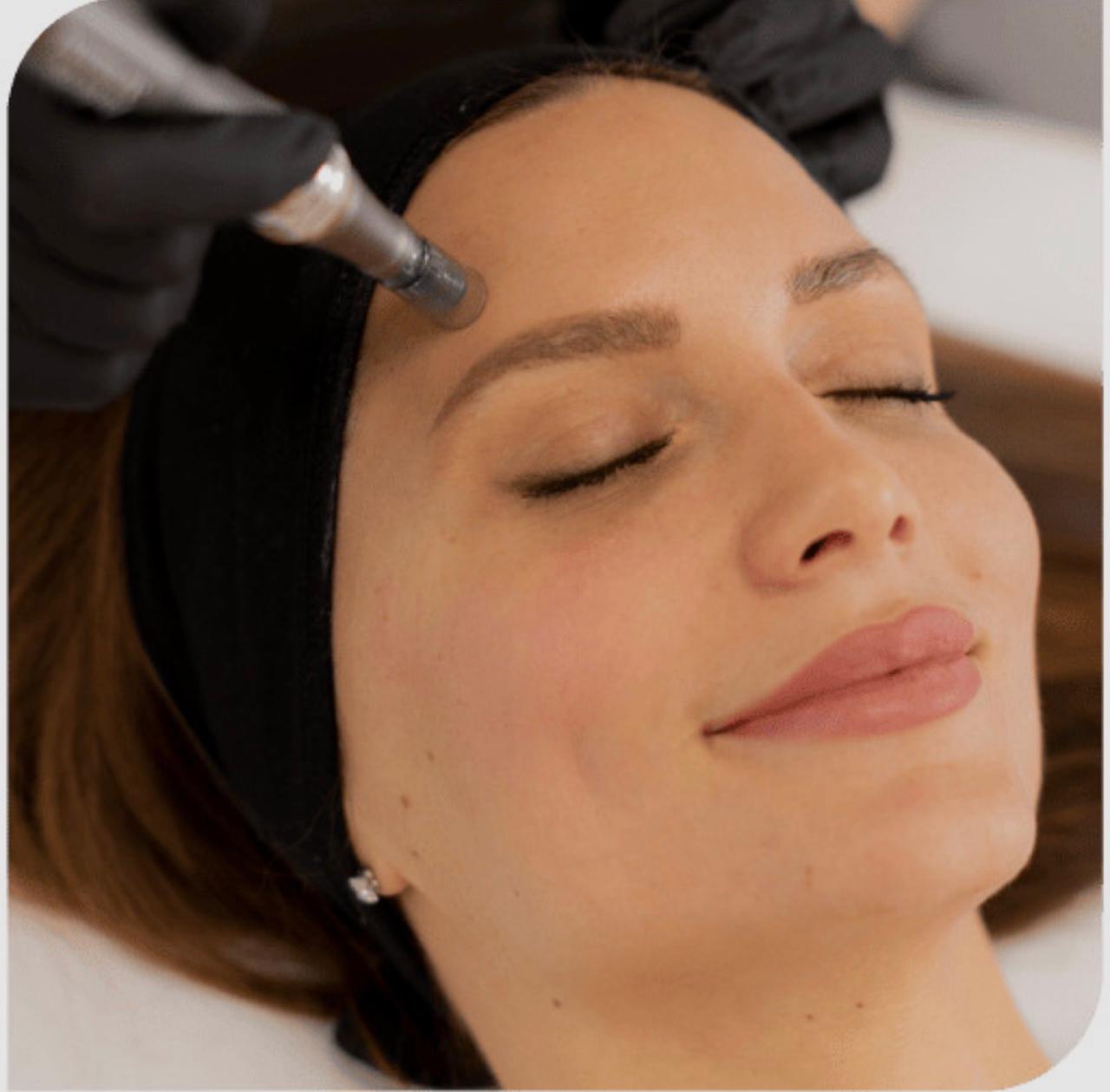 Microagulhamento Facial